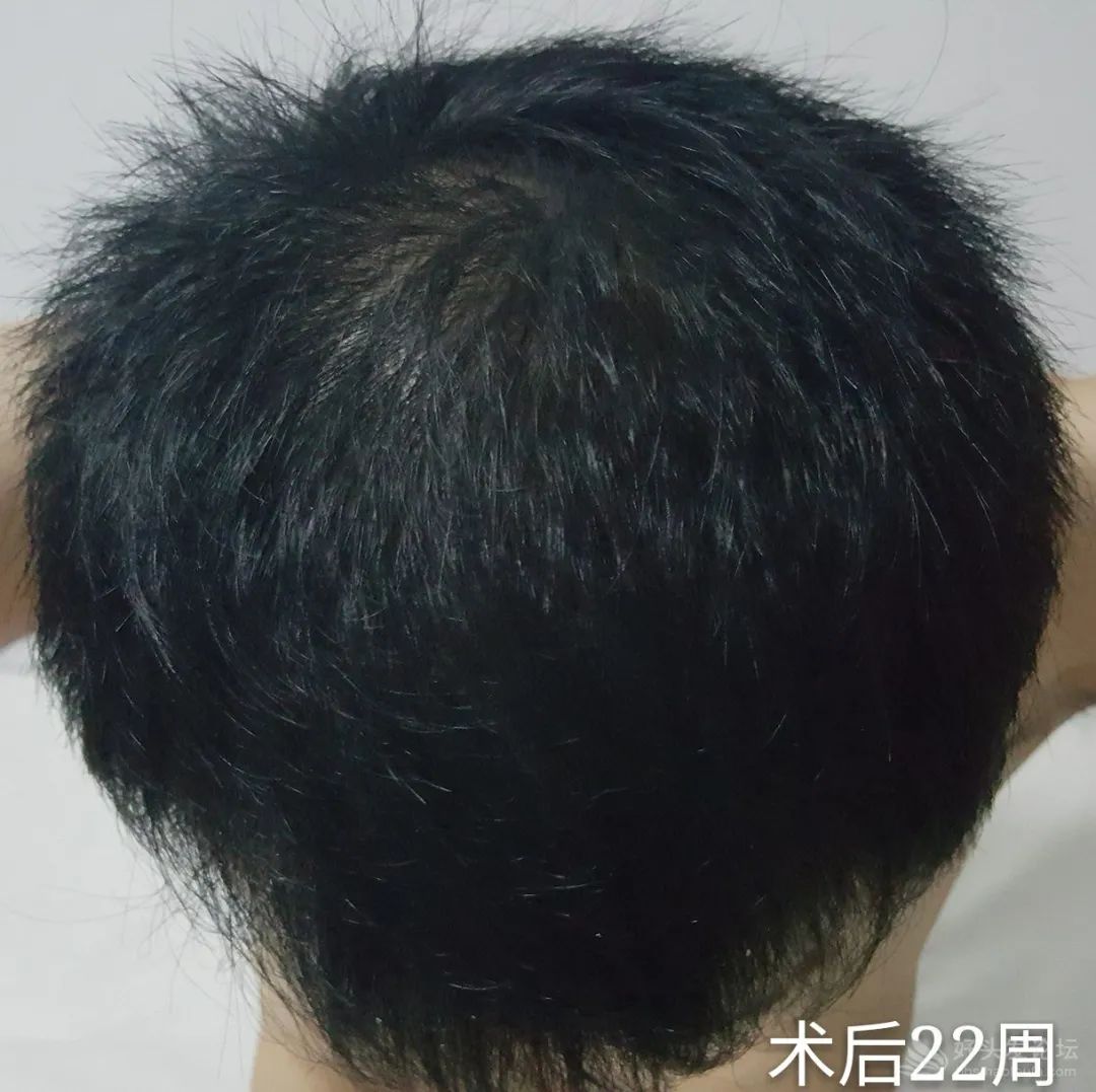 外科医生脱发十年,用了11个月完成自救