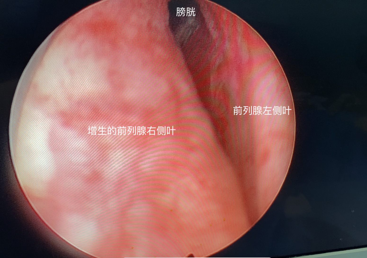 前列腺增生都有哪些危險因素 讀者可以從哪些方面注意 泌尿外科韶雲鵬 Mdeditor