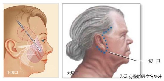 做“拉皮手术”的过来人，同各位姐妹分享18个真相