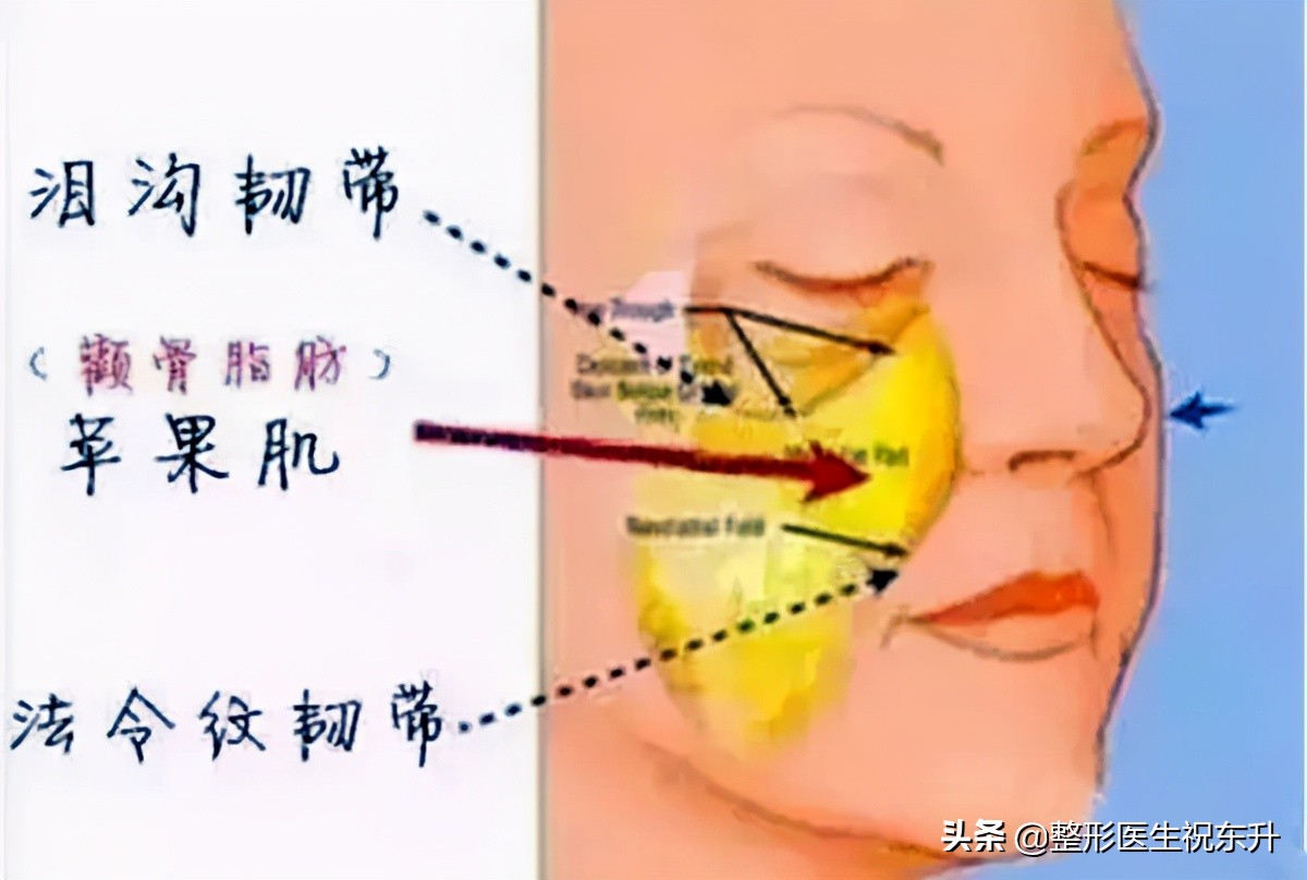 中面部的衰老“三件套”：泪沟、苹果肌下垂和法令纹