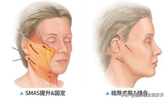 扒一扒“线雕、超声刀和拉皮手术”的那些事