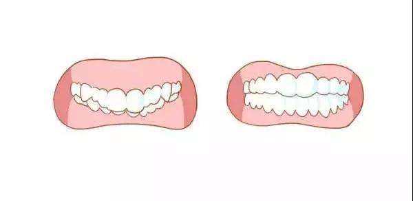龅牙严重影响面部美观，一笑就露牙龈，牙医告诉你该怎么矫正