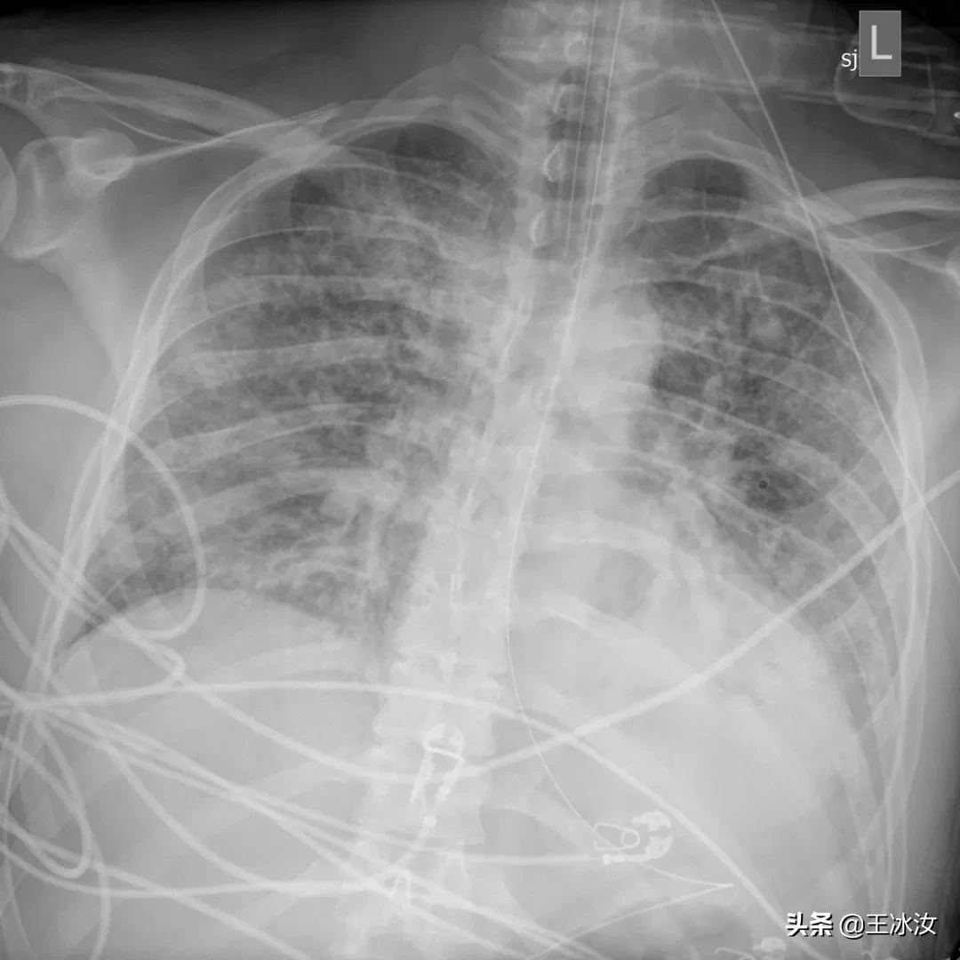 瑞德西韦真成特效药了！重生的美国新冠患者，靠得却不只是神药