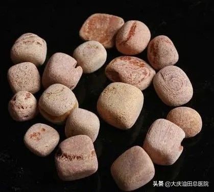 超大碎石怎么做，「3個(gè)月&40分鐘」粉碎4厘米腎結(jié)石