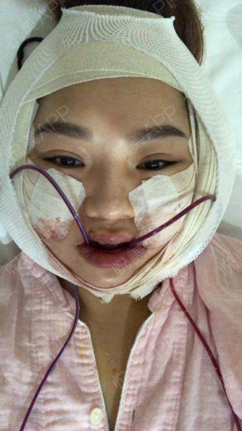 那些一刀切削骨的明星还好吗后遗症一大堆小方脸成最大赢家