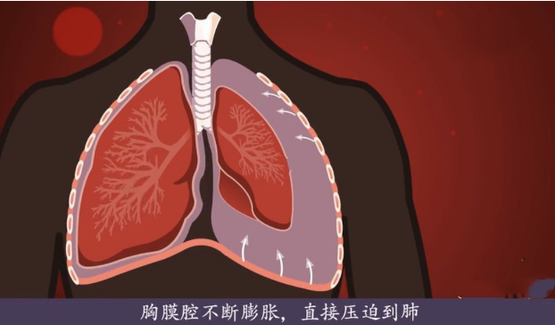 胸腔积液如何“未卜先知”？注意留意这些症状