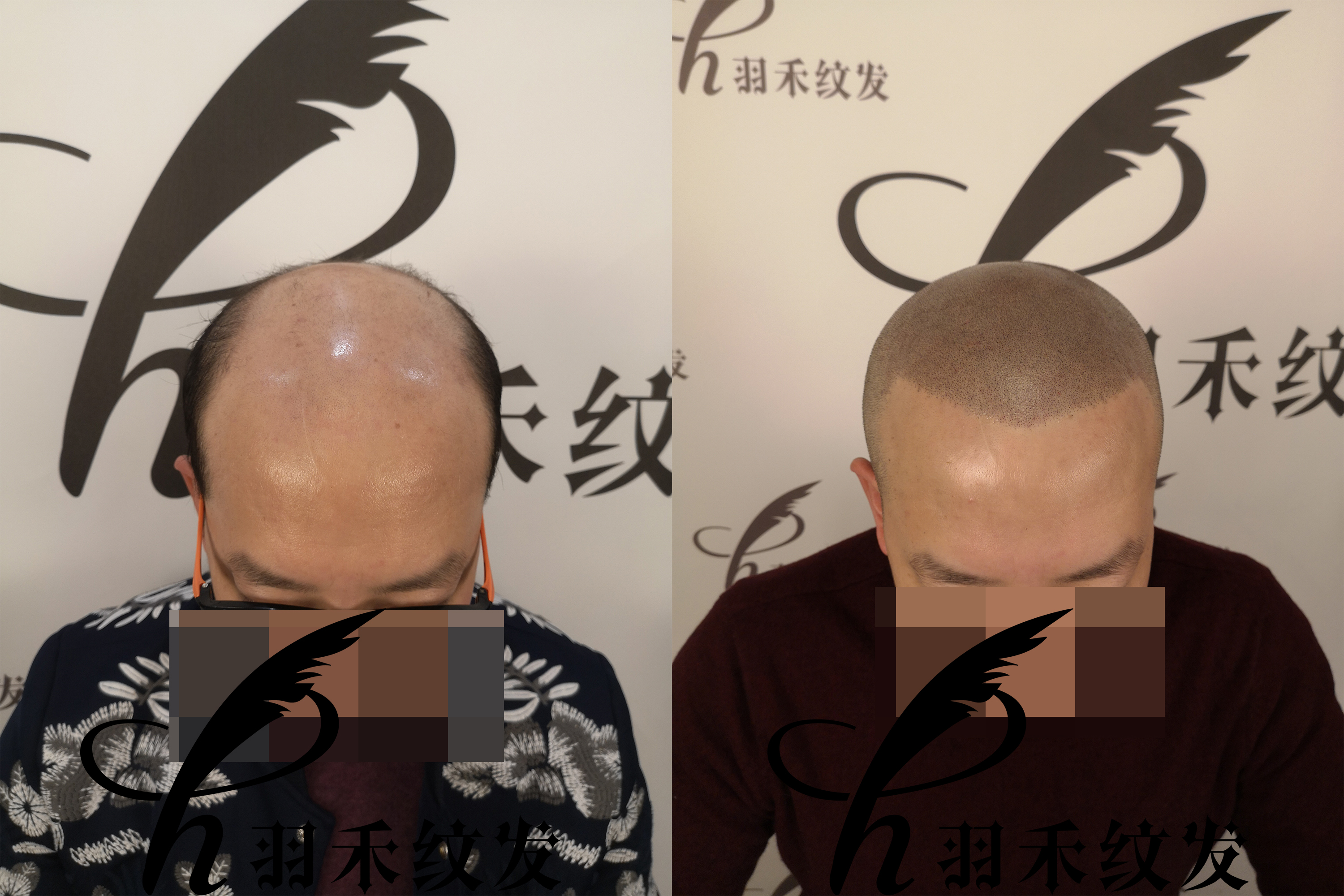 纹发后还能戴假发吗？