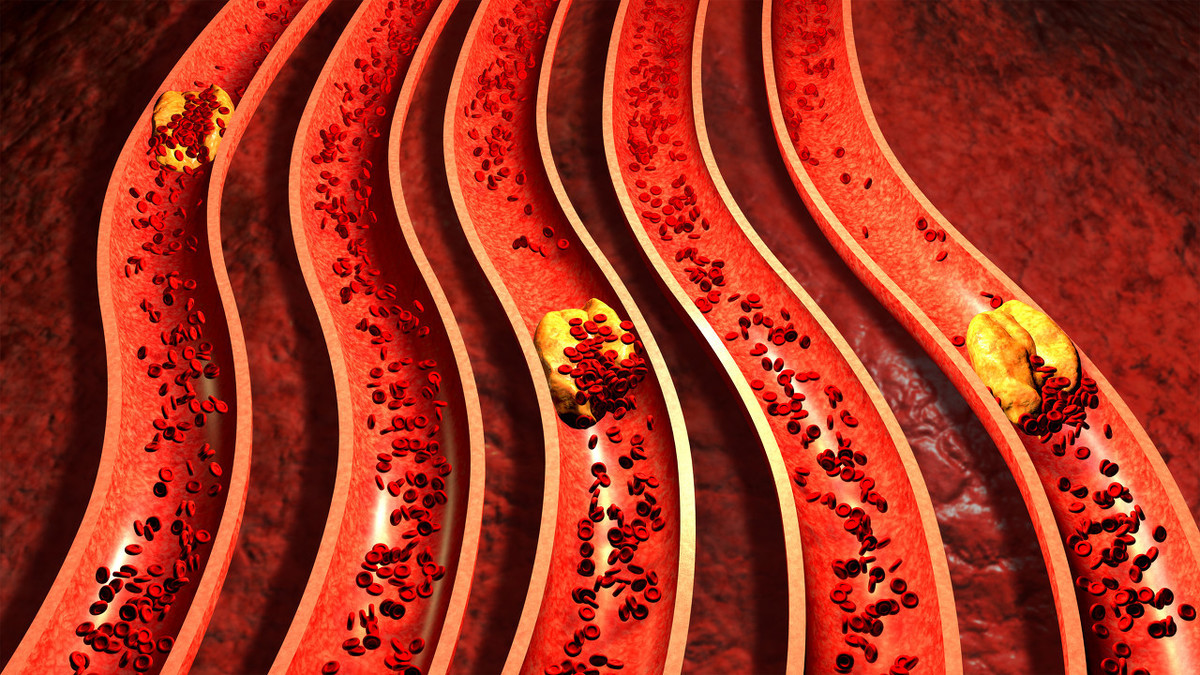 降脂藥�他汀�，傷肝不能長期吃？ 怎麼吃才更安全？