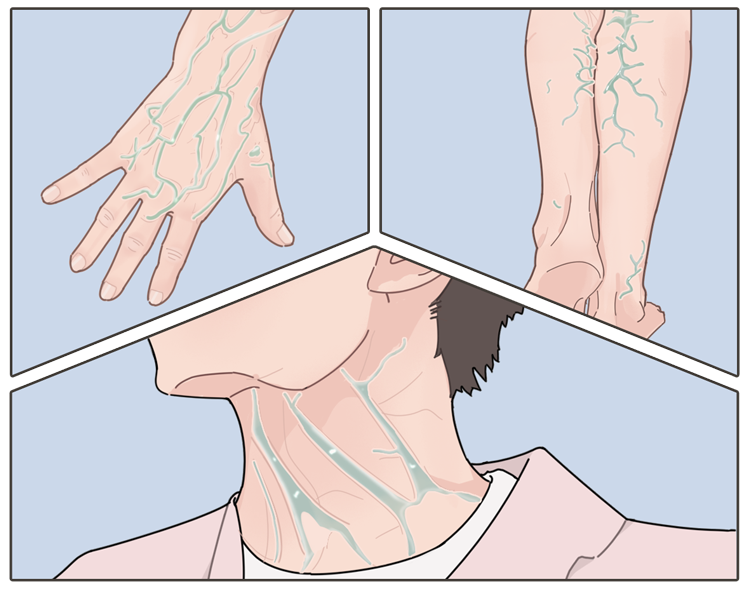 身上4個部位的青筋凸起 或是身體在 報警 及時檢查 39健康網 Mdeditor