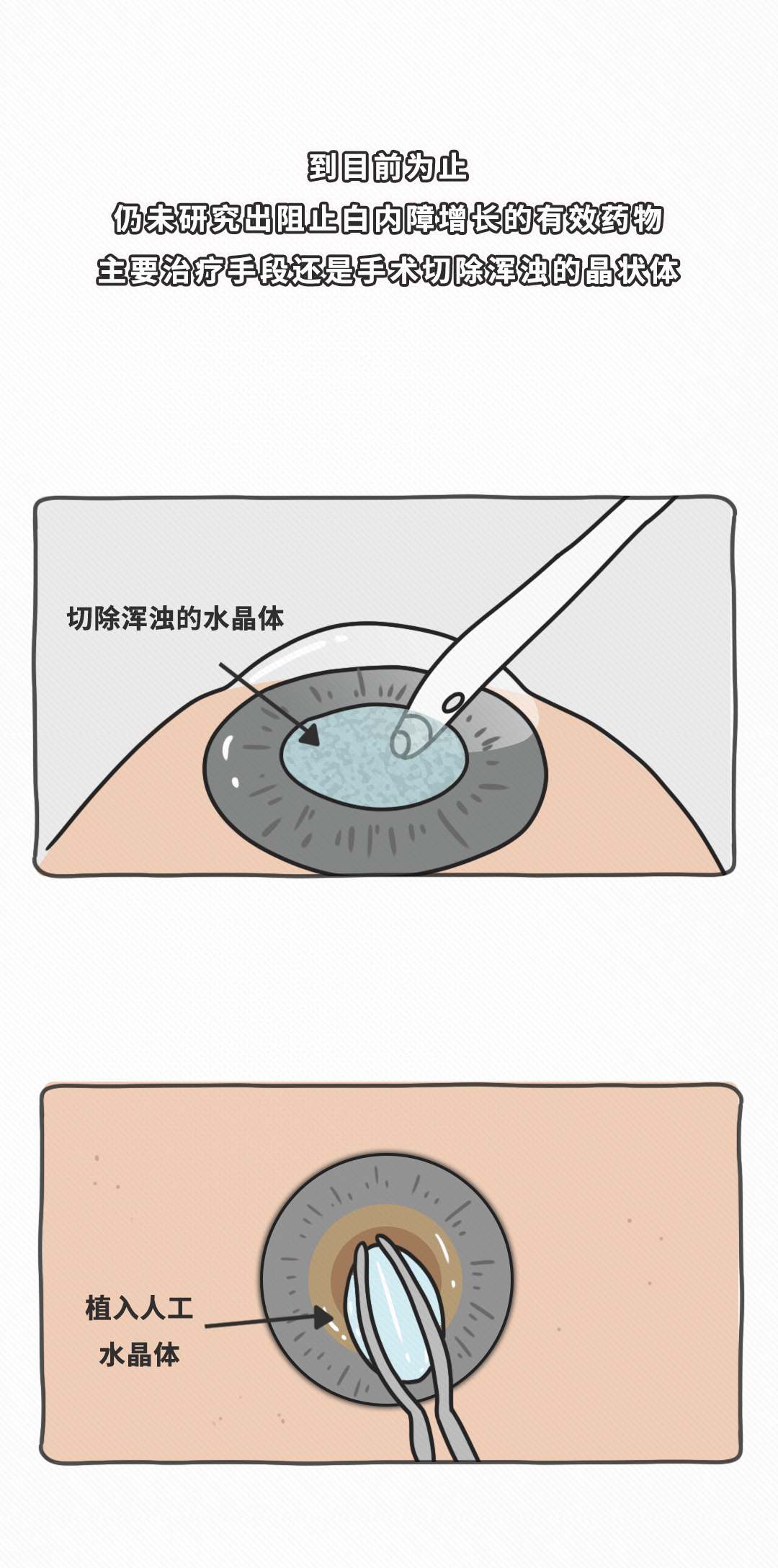 如果你的視野裏有異樣，可能是得了這些眼疾