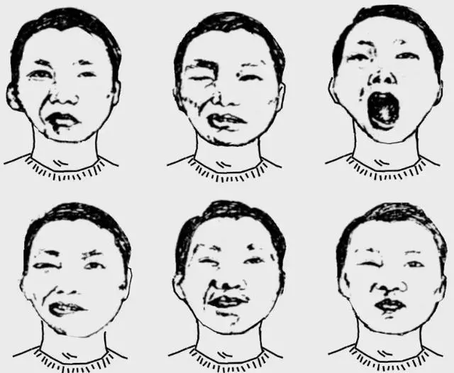 或说不清话,难以吞咽,有的还会表现出扭转痉挛和痉挛性斜颈的一些症状