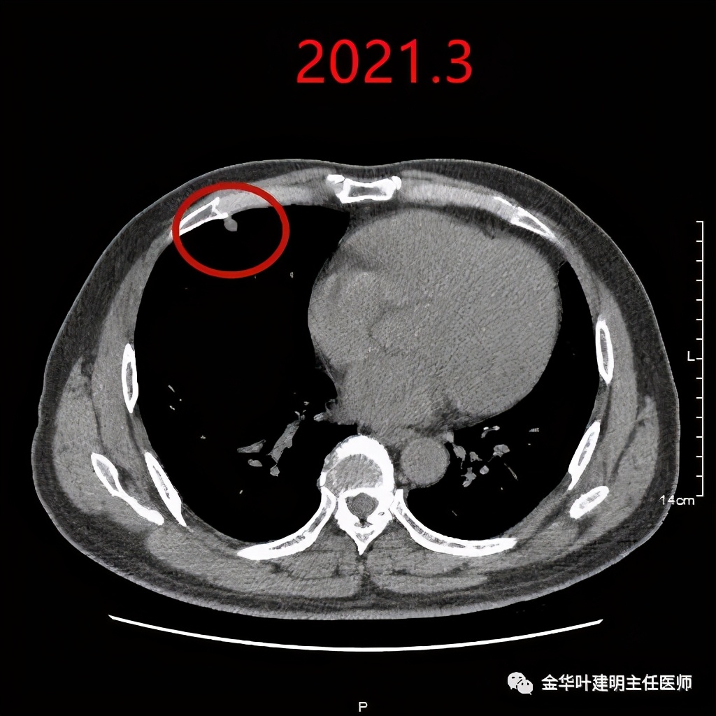 磨玻璃還伴血管穿行的肺結節真的是肺癌嗎