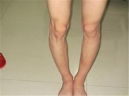 走路姿勢，透露出健康問題，這7種情況，你佔了幾個？