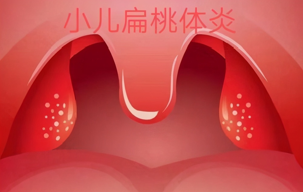 急性扁桃体炎总是“偏爱”孩子，家长别再当成只是普通感冒而已