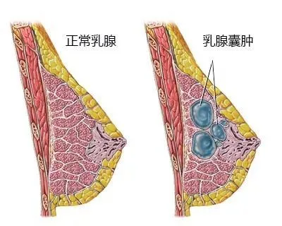 查出这些乳腺疾病别太着急，大部分是良性的
