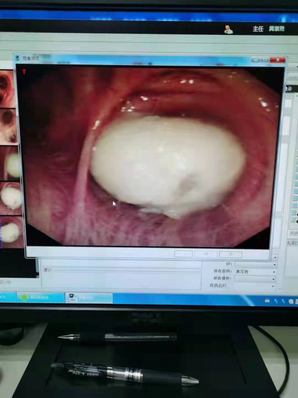 危急！82岁老年患者被“鱼丸”卡住