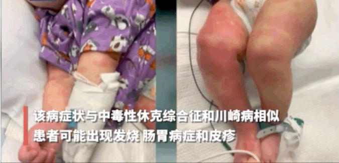 纸包不住火，美国野生动物身上发现新病毒，时