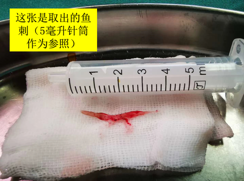 一个月拔500根鱼刺！富阳阿姨开胸取刺才保住命，都怪一碗酸菜鱼！
