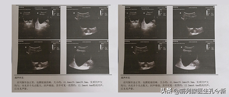 前列腺钙化要不要治？与其忐忑多疑拖长病程，不如早治早康复