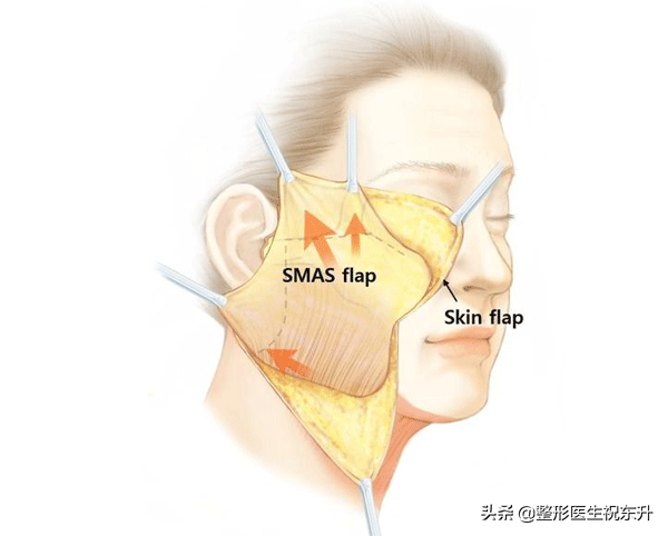 医美整容当中，最可怕的就是“拉皮手术”?