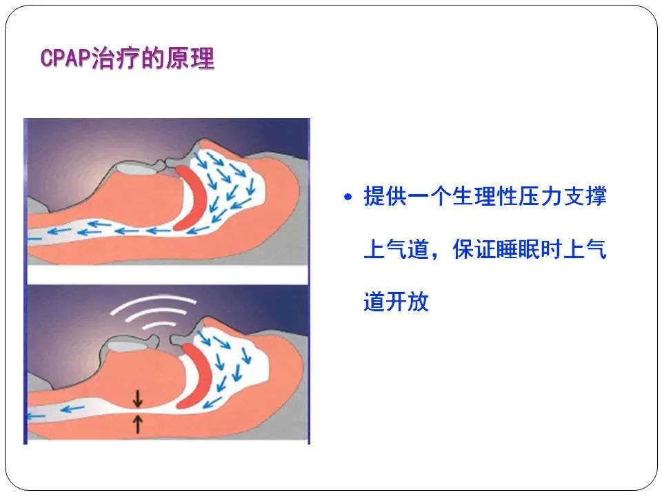 “睡眠呼吸暂停与心血管风险”健康大课堂