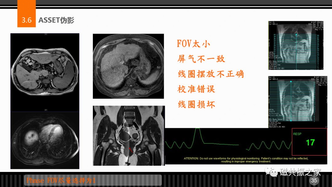 磁共振常见伪影及策略