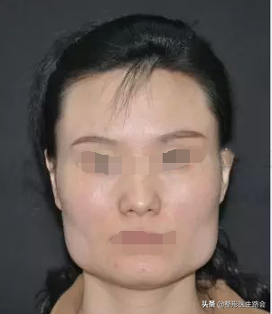想了解一下：打瘦脸针会不会痛？时间长了会反弹吗？