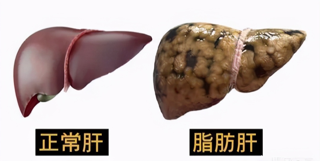 得了脂肪肝，你还在盲目运动？这4类人小心加重病情