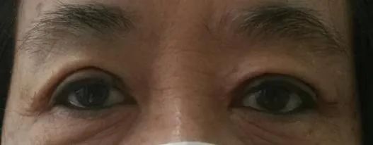 科普——眼整形手术是个什么手术?(多图)