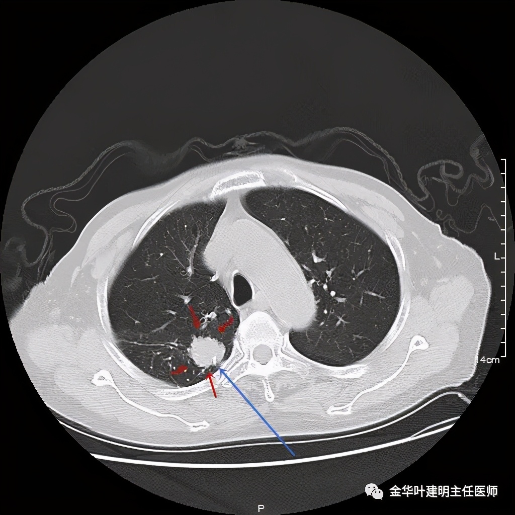 紅色箭頭示病灶輪廓較清楚;粉色箭頭示原手術楔形切除的吻合器釘子,呈