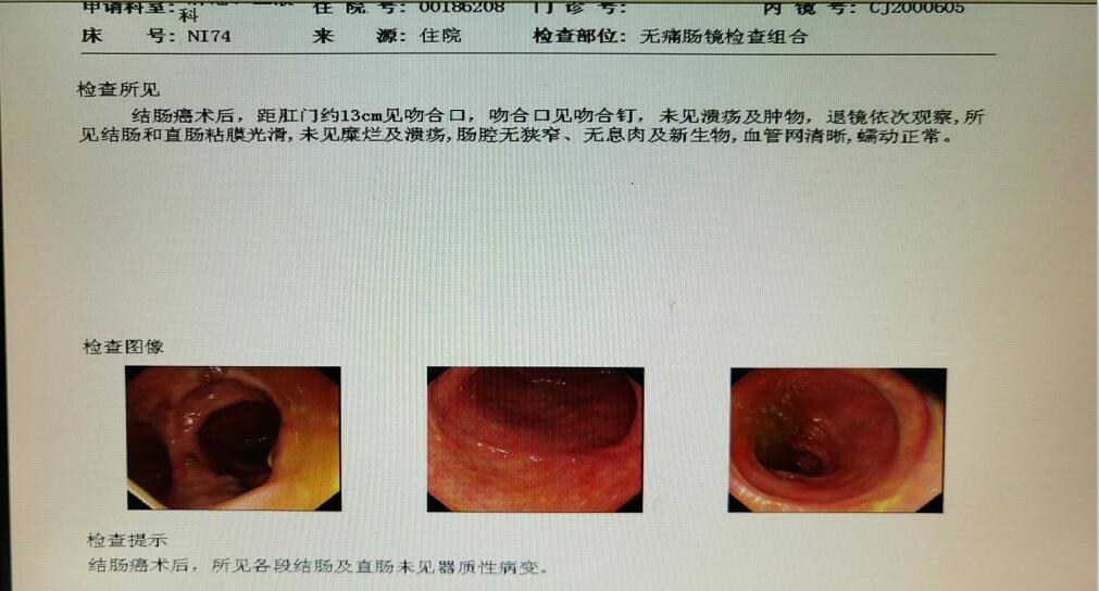 出現便血，是腸癌還是痔瘡？ 醫生教你從三方面辨別，別再混淆了