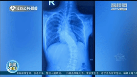 6小时，&ldquo;长高&rdquo;10厘米！一场脊柱重建手术让驼背男孩挺起胸膛