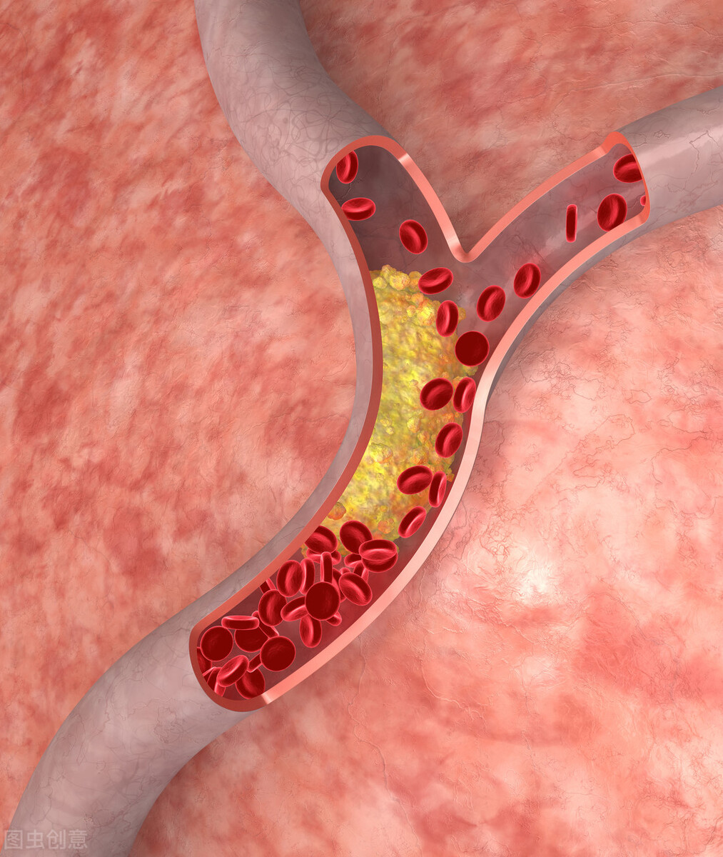 這4件事對於軟化血管有幫助，能夠預防動脈硬化