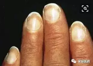 指甲上有白点，并非缺钙或贫血
