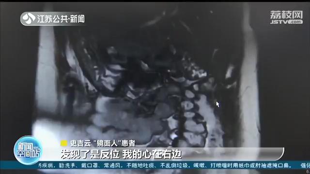 罕见&ldquo;镜面人&rdquo;手术需要反着做主刀医生顺利完成