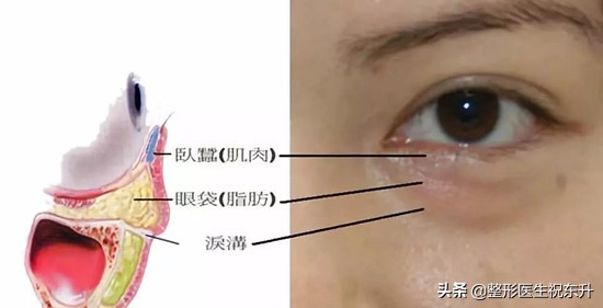 去除眼袋、泪沟第6天，闺蜜夸我“恢复的太快了”