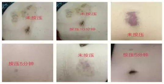 低分子肝素钙注射后按压5分钟还是10分钟？没想到区别竟这么大