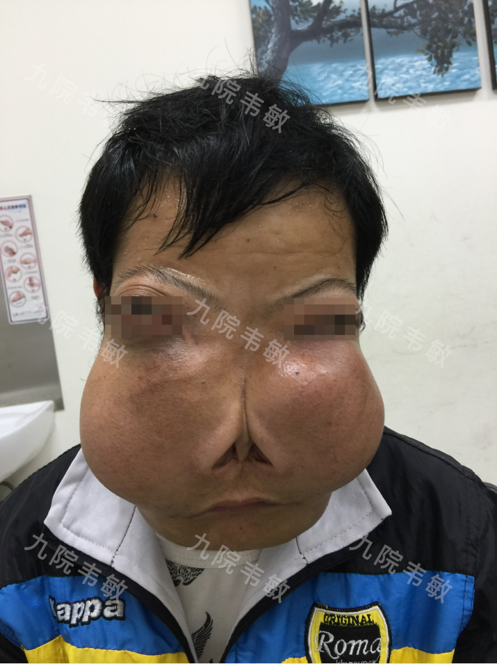 因怪病导致长相怪异的患者让我想起10年前的另一个患者
