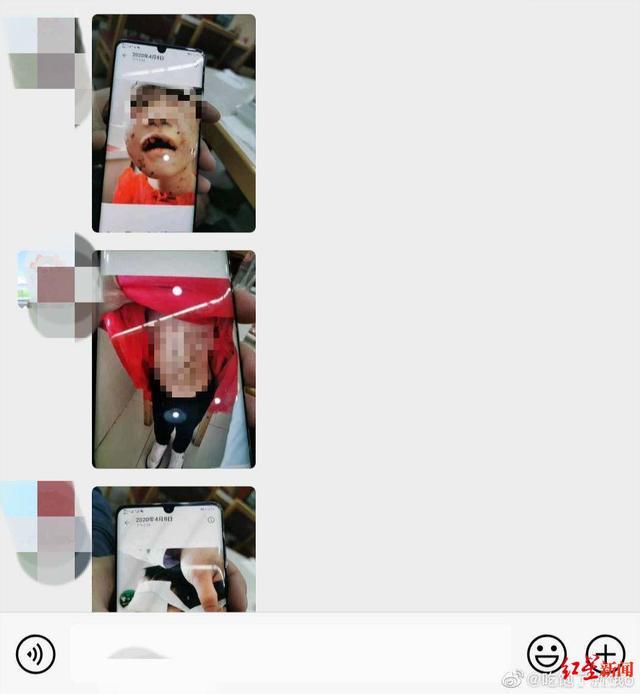 令人发指！这个恶魔后妈，剪开了4岁女孩的嘴唇