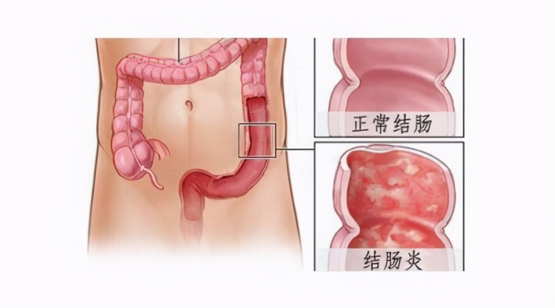 結腸炎屬於癌前期病變 氫氣控制結腸炎 預防結腸癌 胃腸醫生葉金梅 Mdeditor