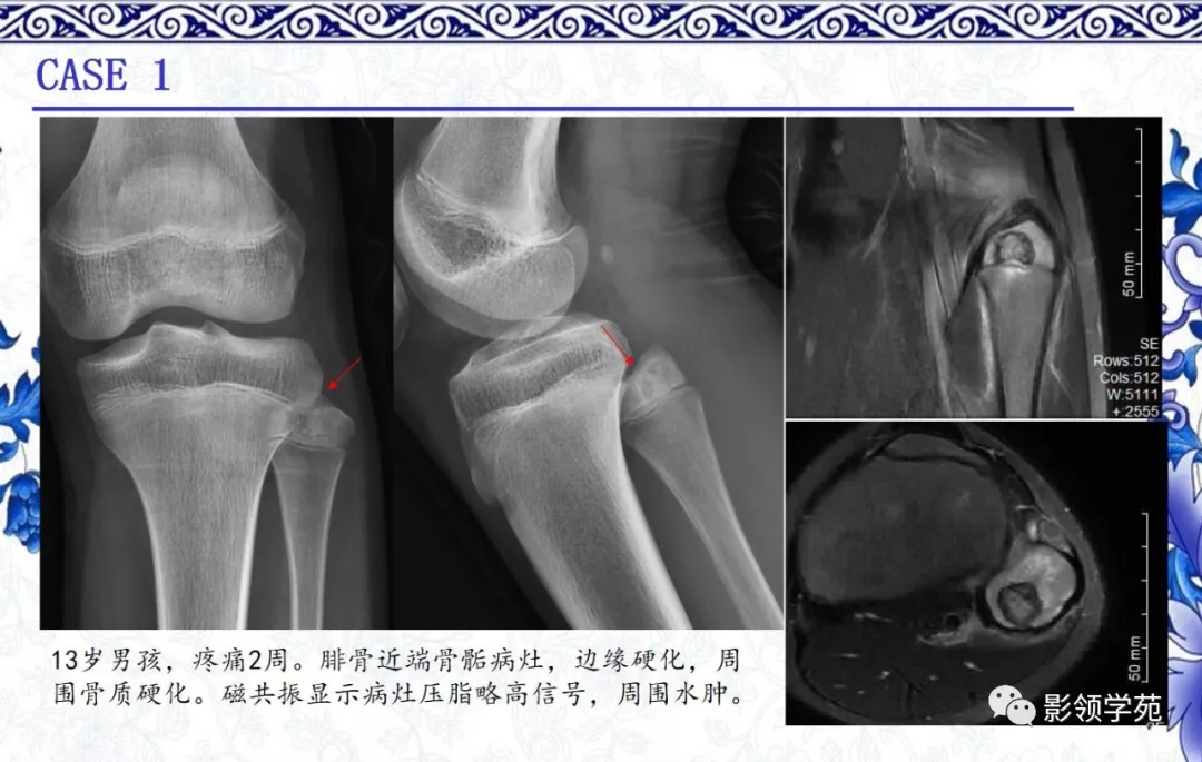 7种常见的软骨源性肿瘤的影像表现