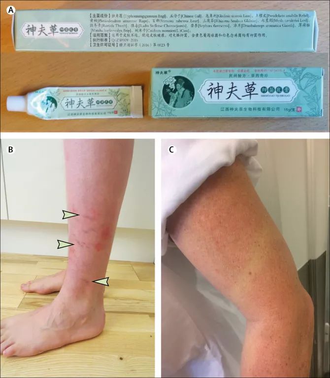 注意！这款畅销了10年的“中草药膏”竟含激素！被世界**医学期刊点名！