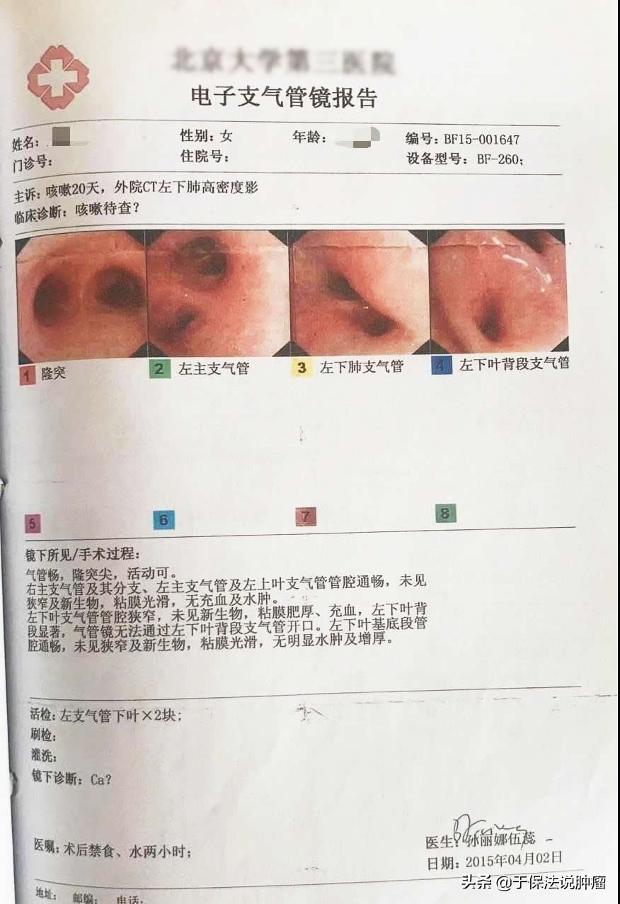 左肺下叶肿瘤，经缓释库超微创靶向治疗，生存超过6年