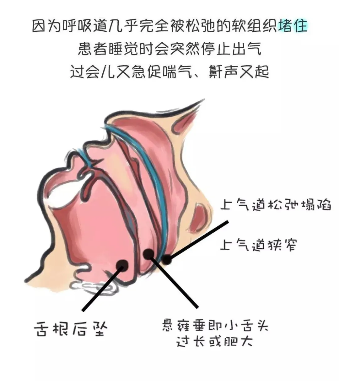 一夜断气417次，266斤胖大姐睡觉打呼差点“送”走自己！为啥打呼噜要人命？