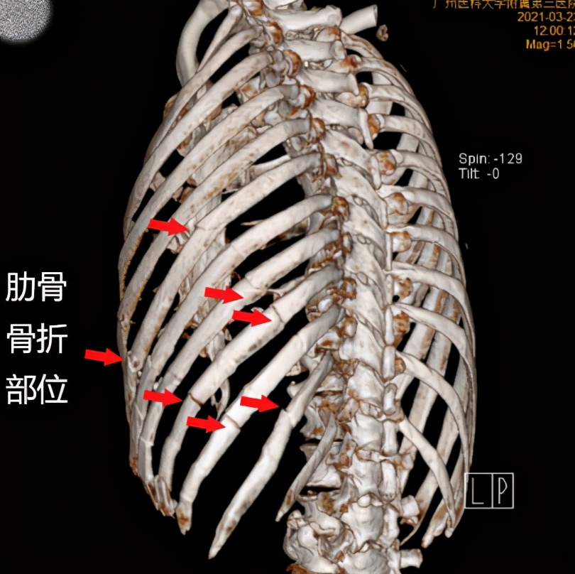 104歲老人意外摔斷7根肋骨 11處骨折 緊急進行 接骨 手術 健康養生週刊 Mdeditor