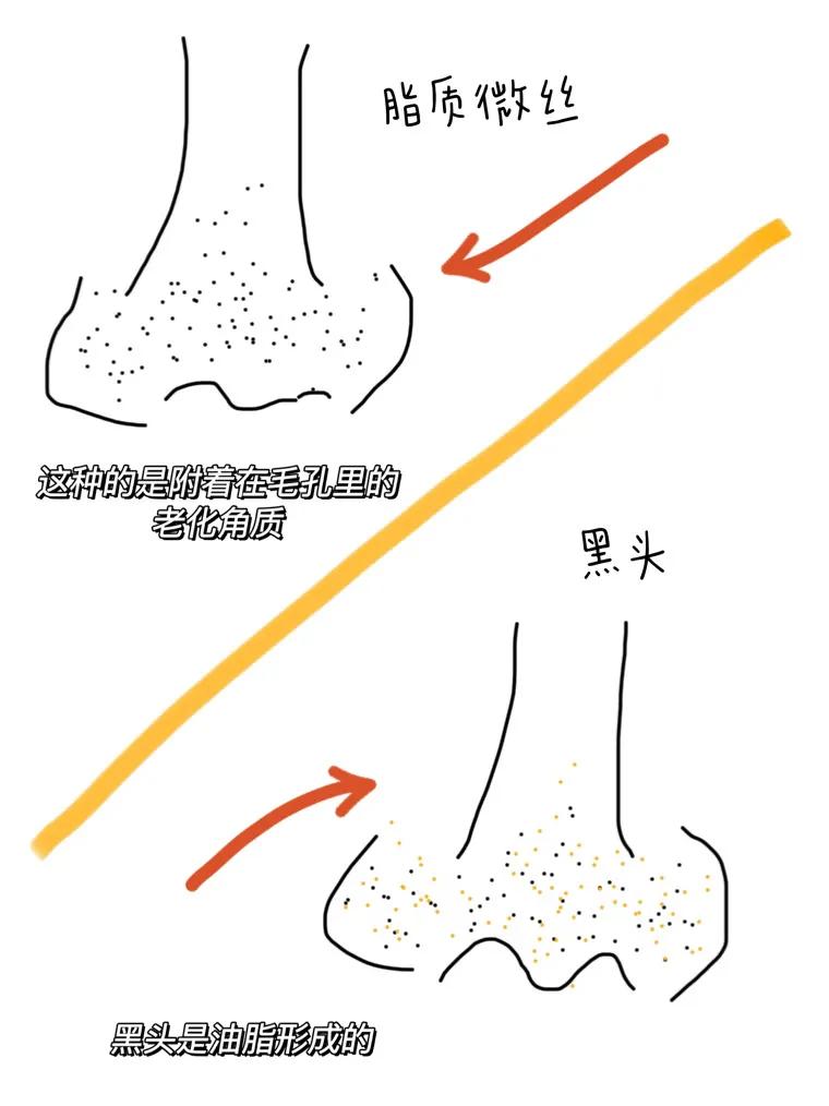 姐妹們原來這樣去黑頭才是正確的