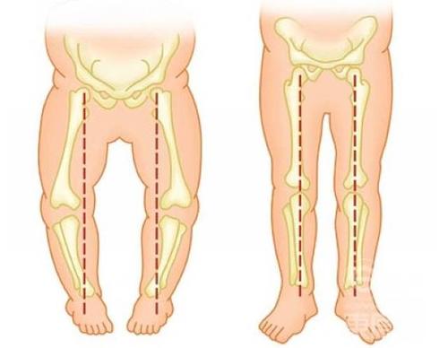 走路姿勢，透露出健康問題，這7種情況，你佔了幾個？