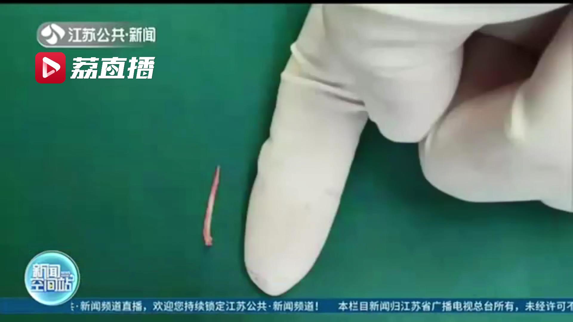 喉镜胃镜皆不见鱼刺 医生实施全麻手术进行“地毯式”排查