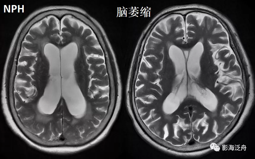 小心误诊，这可不是单纯的脑萎缩