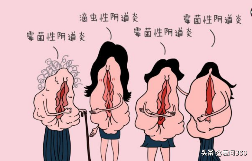 陰道炎容易反復發作，用這6個方法提前預防陰道炎的發生